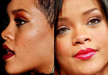 Rihanna-Acne-Scars.jpg